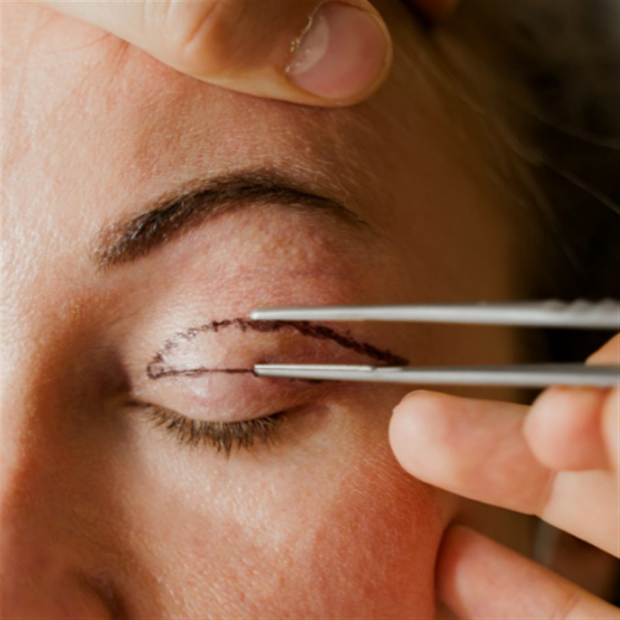 Blepharoplasty in Jalandhar consultation