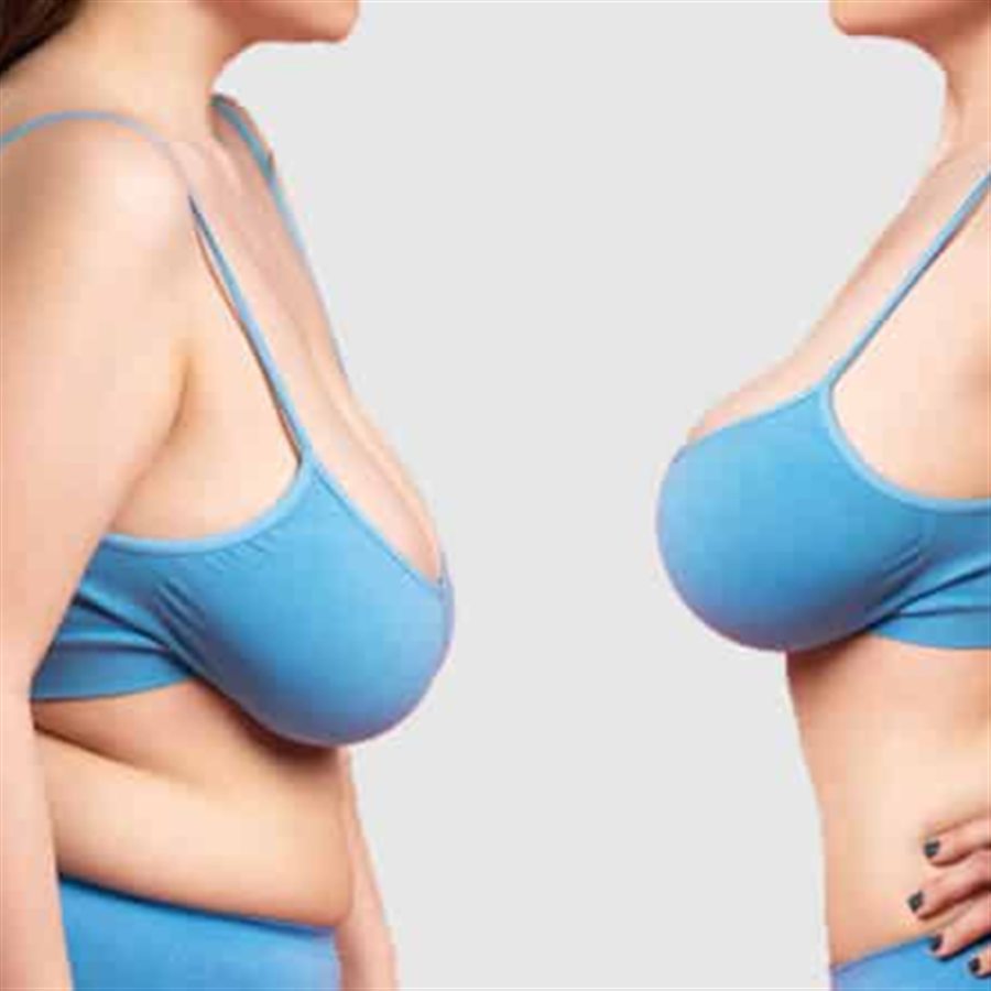 Breast reduction in Jalandhar consultation