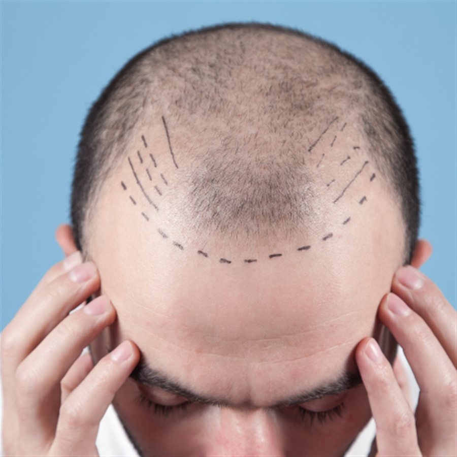 Hair transplant in Jalandhar consultation