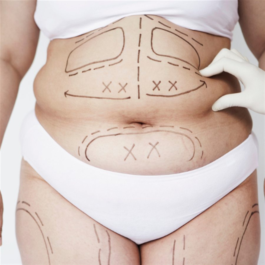 Liposuction in Jalandhar consultation