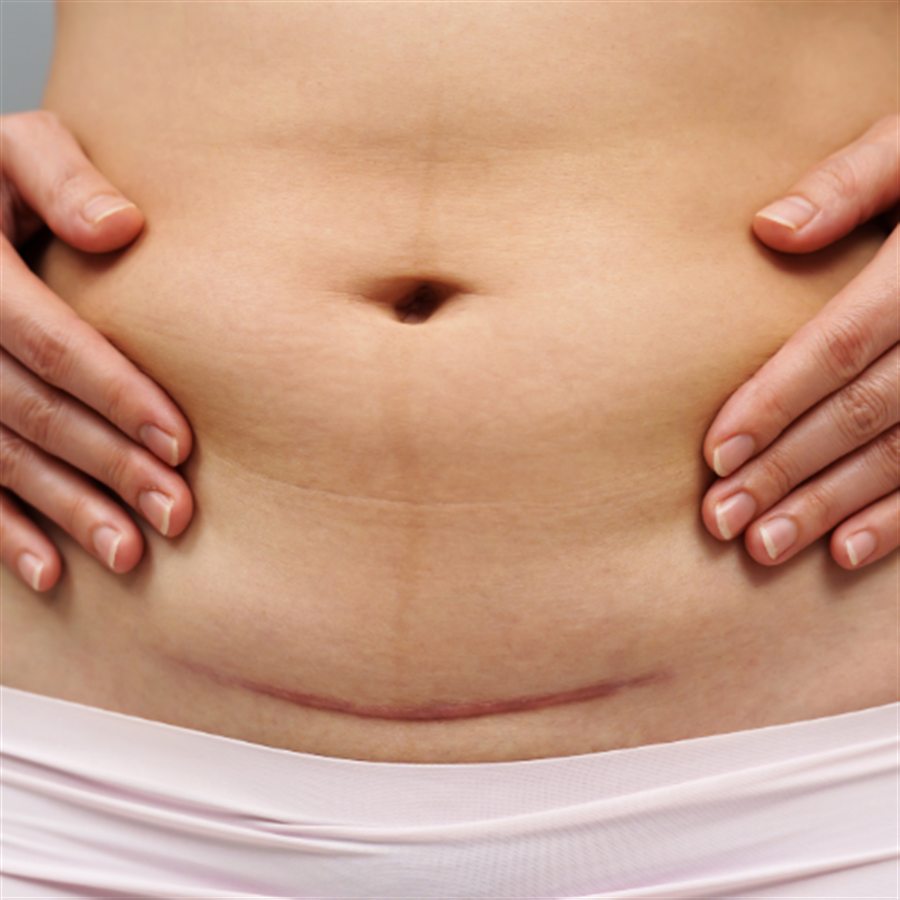 Scar revision in Jalandhar consultation